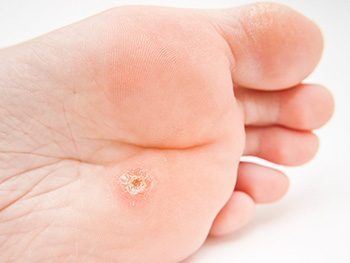 Wart removal