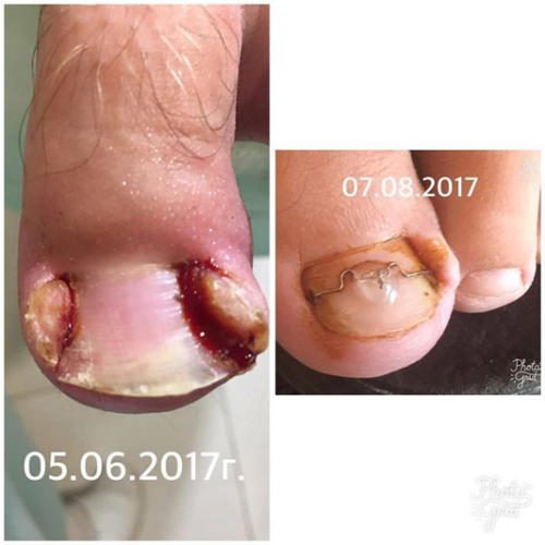 Лечение воспалительного процесса при вростании ногтя — Марчук Евгения Анатольевна
