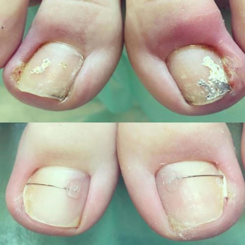 Лечение вросшего ногтя с помощью скобы Combiped — Марчук Евгения Анатольевна