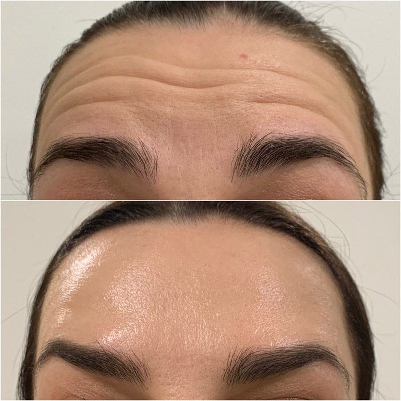 Beauty injections / 3D face lifting