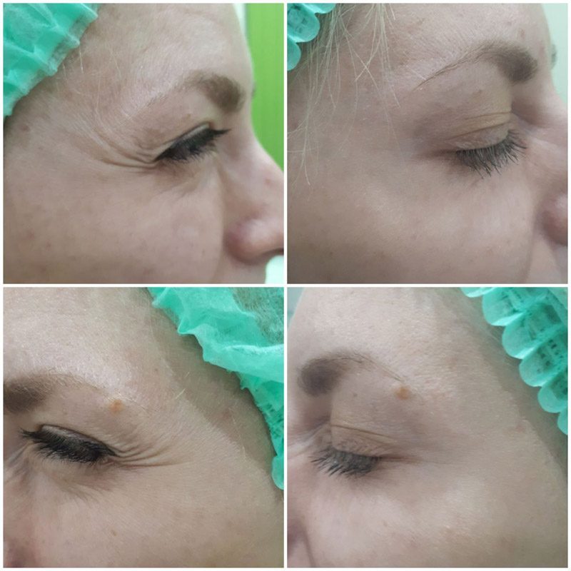 Beauty injections / 3D face lifting