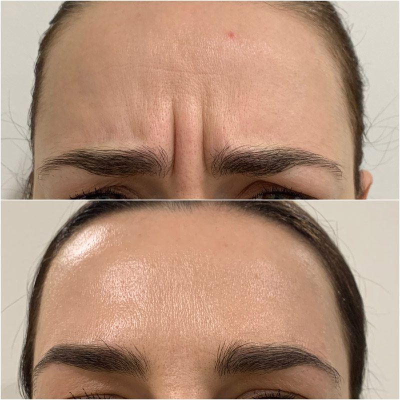 Beauty injections / 3D face lifting