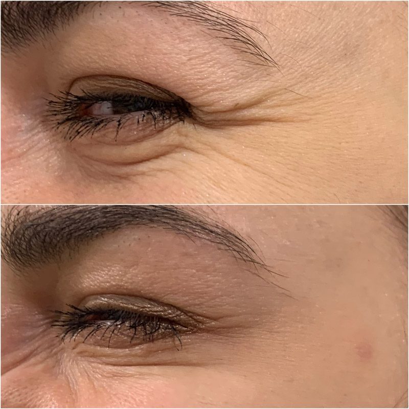 Beauty injections / 3D face lifting