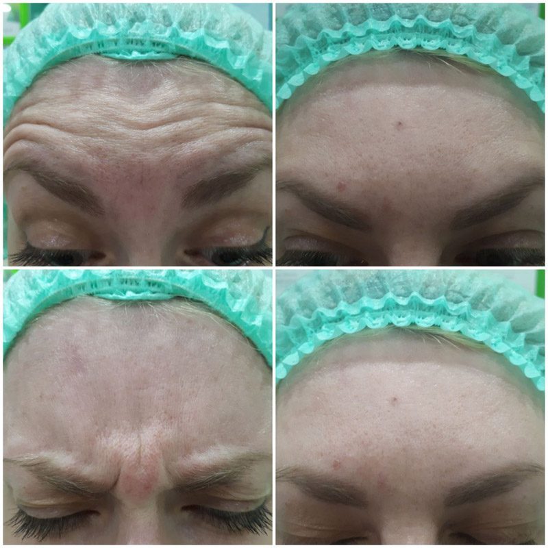 Beauty injections / 3D face lifting