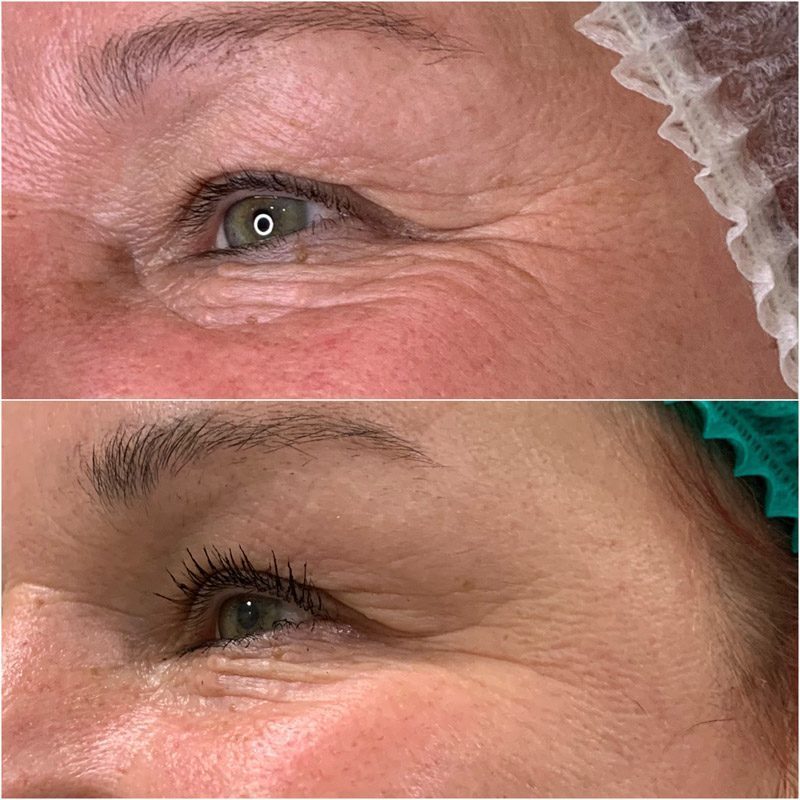 Beauty injections / 3D face lifting