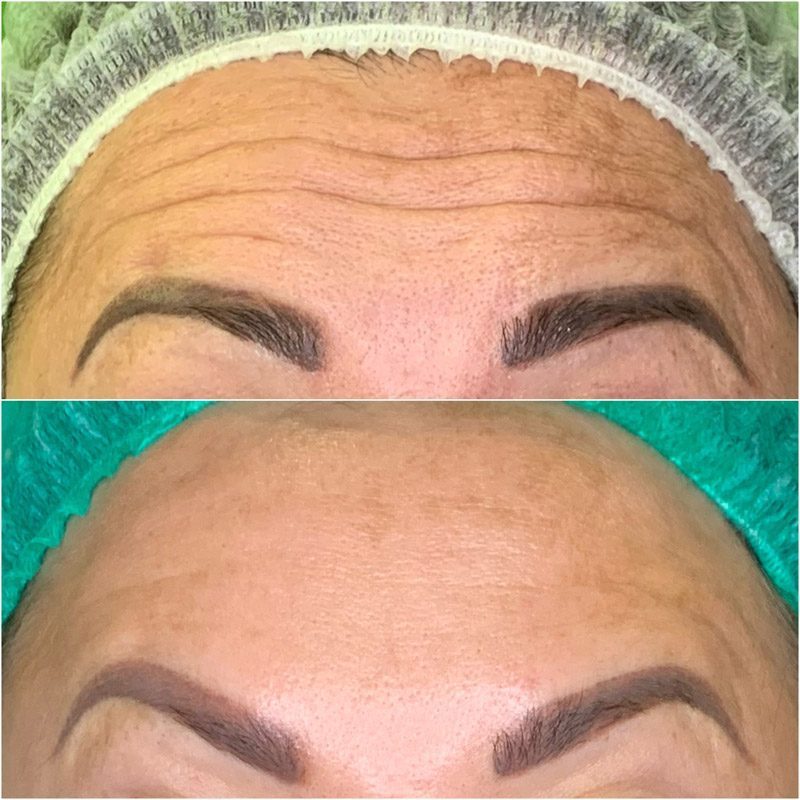 Beauty injections / 3D face lifting