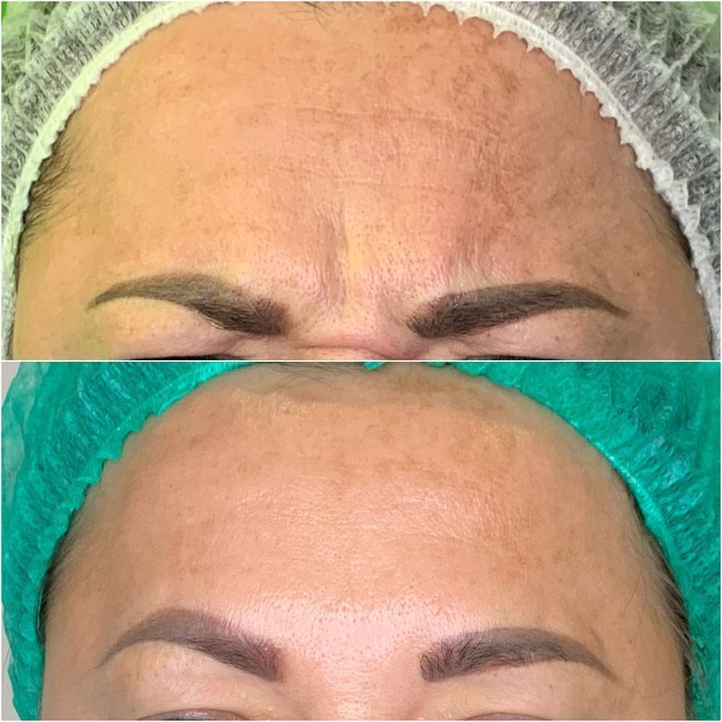 Beauty injections / 3D face lifting