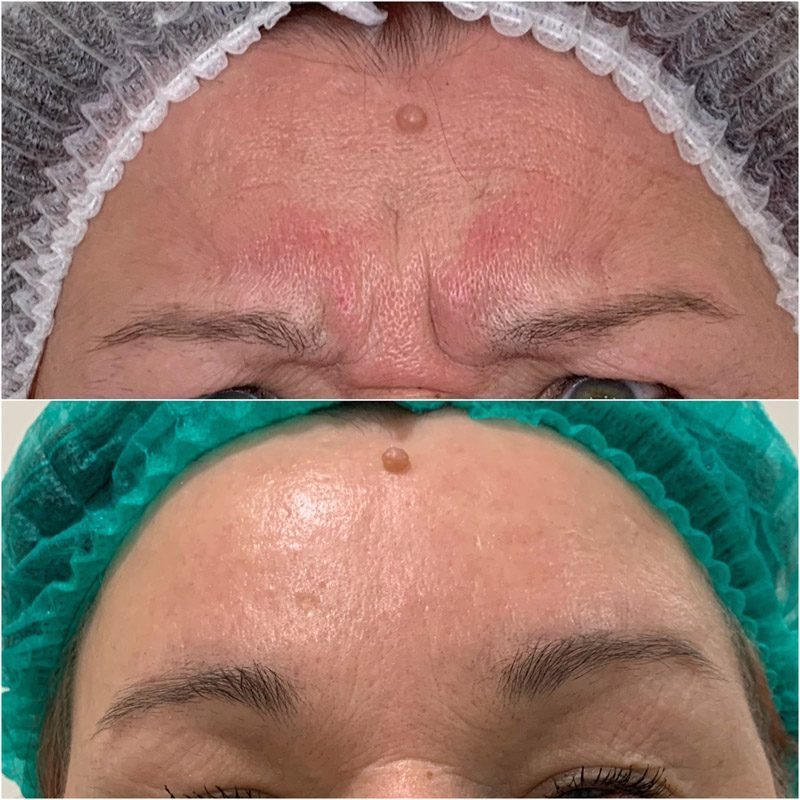 Beauty injections / 3D face lifting